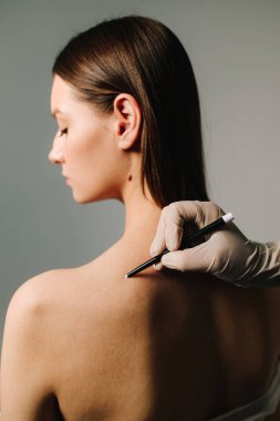 Migren tedavisi için deri hazırlama. Baş ağrısı ve ağrı kesicilerin tedavisi. Doktor tarafından migren tedavisi için işaretlenmiş deri