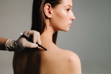 Doktor tarafından migren tedavisi için işaretlenmiş deri. Migren tedavisi için deri hazırlama. Baş ağrısı ve ağrı kesicilerin tedavisi