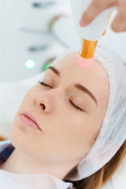 Hasta yüzündeki küçük damarların lazer teçhizatla çıkarılması. Güzellik uzmanının IPL ekipmanlarıyla Rosacea lazer tedavisi