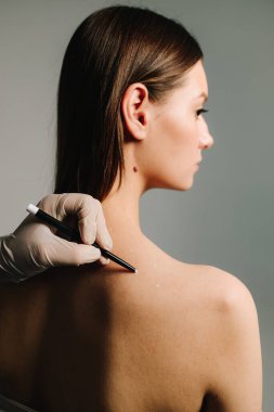 Doktor tarafından migren tedavisi için işaretlenmiş deri. Migren tedavisi için deri hazırlama. Baş ağrısı ve ağrı kesicilerin tedavisi