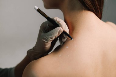 Migrenden kalma deri ve terapi için ağrı kesici. Yüksek kaliteli bir uzman tarafından acısız tedavi. Doktor, migren tedavisi için sırt derisine işaretler çizer.