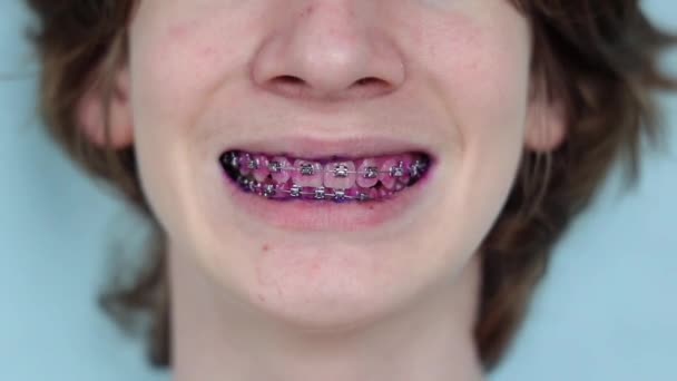 Indicateur Plaque Sur Les Dents Humaines Avec Accolades Plaque Couleur — Video