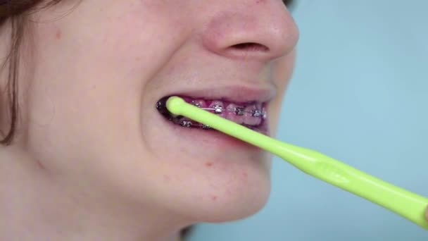 Ένδειξη Πλάκας Ανθρώπινα Δόντια Σιδεράκια Πλάκα Έχει Χρώμα Ροζ Teenager — Αρχείο Βίντεο
