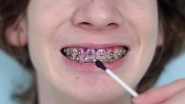 Indicador Placa Dentes Humanos Com Aparelho Placa Cor Rosa Adolescente — Vídeo de Stock