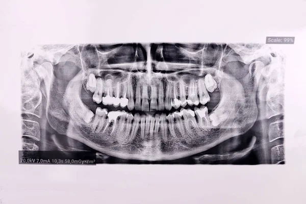 Exame Radiológico Dente Dental Panorâmico Mandíbula — Fotografia de Stock