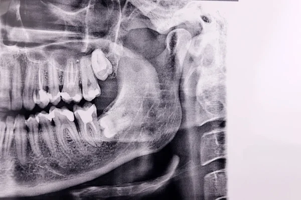 Horizontal wisdom tooth on Panoramic dental tooth X-ray examination