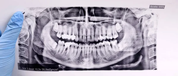 Dentist points finger at wisdom tooth at Panoramic dental tooth X-ray examination