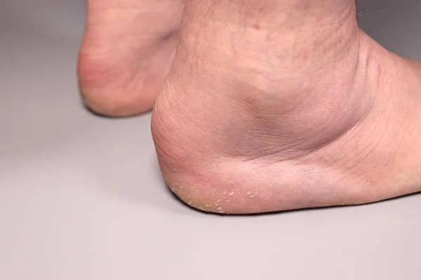 Inflamed, swollen foot, male heel