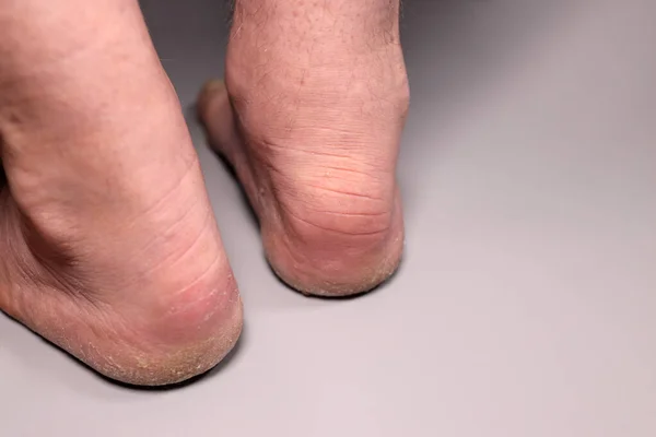 Inflamed, swollen foot, male heel