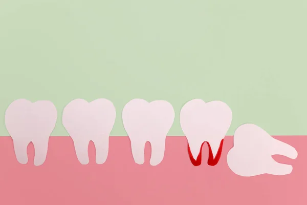 Horizontal Dente Sabedoria Mesial Modelo Papel Conceito Serviços Dentista Cirurgião — Fotografia de Stock