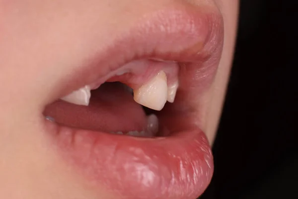 Mund Eines Kindes Ohne Milchzähne Großaufnahme — Stockfoto