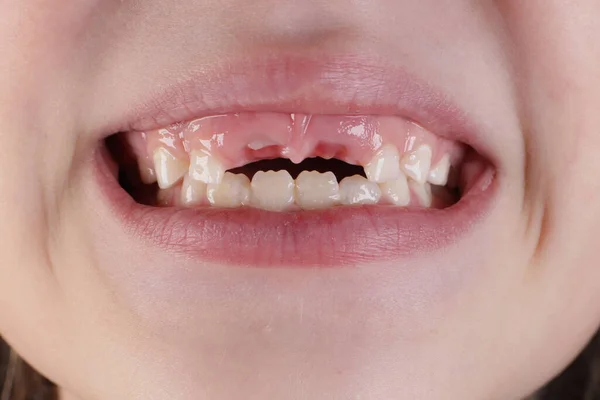 stock image Mouth without front milk teeth close-up