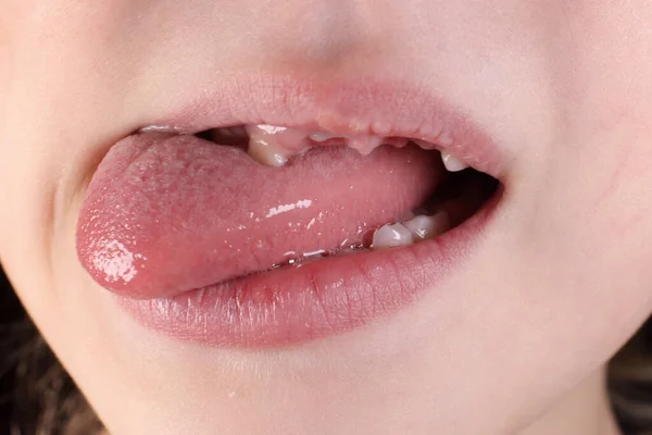 舌を見せる倒れた歯の子供 — ストック写真
