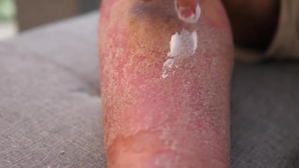 乾癬の救済クリームを適用する男 医学と医療の概念 皮膚の発疹を持つ男 — ストック動画