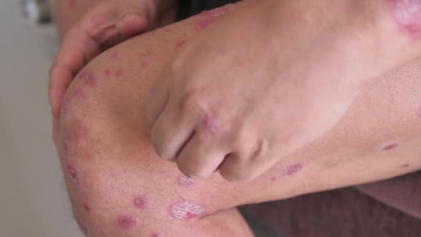 People Scratching Skin Psoriasis — Stock Video