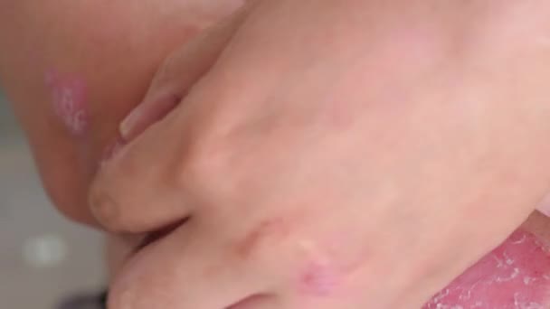 皮膚乾癬を傷つける人々 — ストック動画
