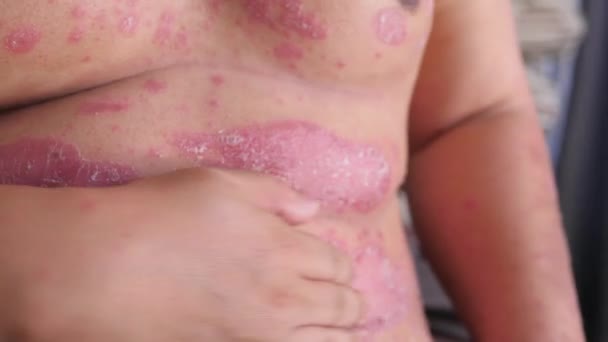 Люди Подряпають Шкіру Псоріаз — стокове відео