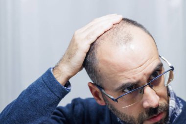 Young man with alopecia looking at his head and hair in the mirror at home