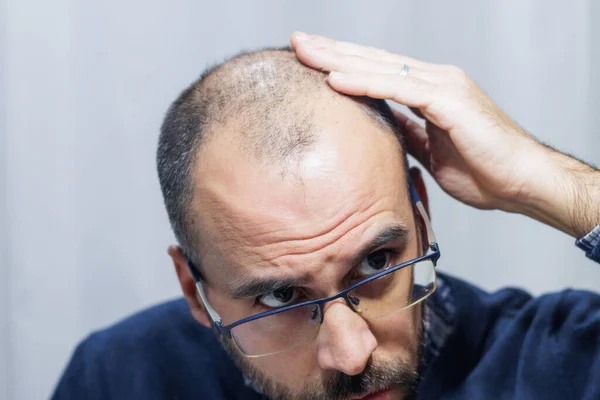 Young man with alopecia looking at his head and hair in the mirror at home