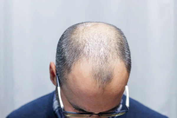 Young man with alopecia looking at his head and hair in the mirror at home
