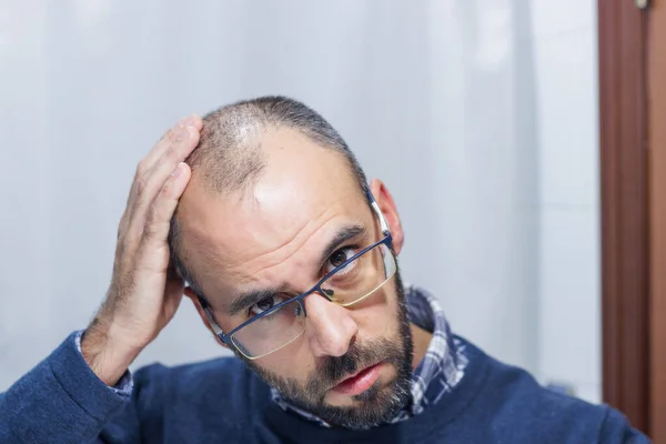 Young man with alopecia looking at his head and hair in the mirror at home