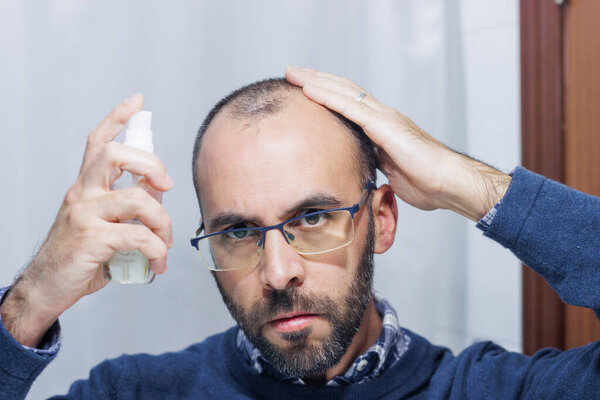 Young man with alopecia looking at his head and hair in the mirror and applying a spray medicine