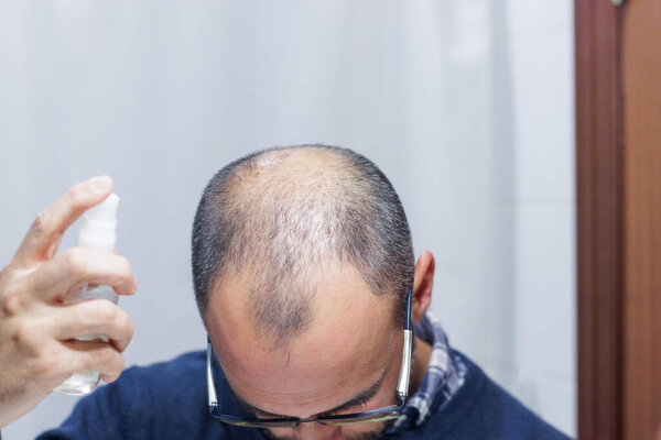 Young man with alopecia looking at his head and hair in the mirror and applying a spray medicine