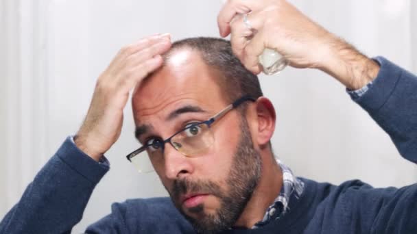 若いです脱毛症の男は彼の頭と髪を鏡で見て 自宅でスプレー薬を適用 — ストック動画