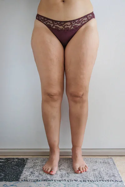 Białe Kobiece Nogi Flab Cellulitu Domu — Zdjęcie stockowe