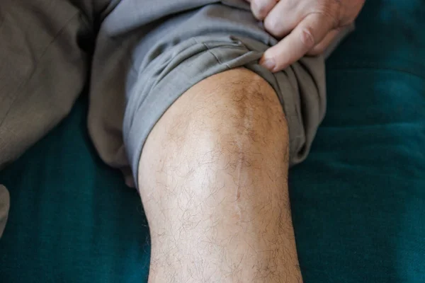 Scar on the knee from a prosthesis, at home
