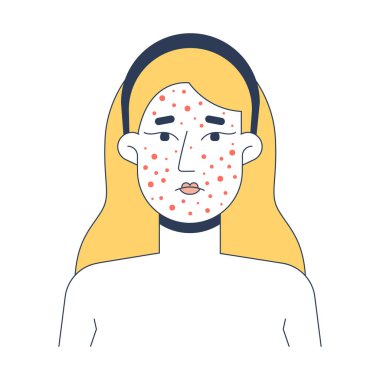 Sarışın kadın sivilceli cilt problemi 2D vektör çizimi. Rosacea yüz kızarıklığı. Beyaz kadın, beyaz arka planda izole edilmiş tahriş olmuş, düz karakterli, beyaz bir sivilce. Renkli çizgi film resmi