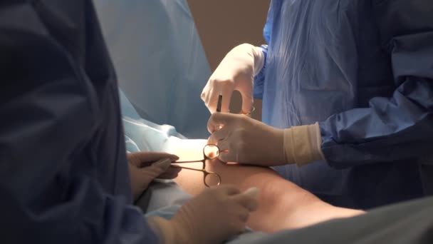 アシスタントを持つ血管外科医は 静脈瘤を除去する手術を行います 医者は現代の診療所で患者を手術する 女性の足のモグラの除去 医者は手術後脚を縫った — ストック動画