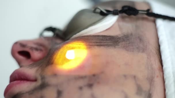 Zbliżenie Strzału Procedura Łuszczenia Się Twarzy Laser Pulsuje Czystą Skórą — Wideo stockowe
