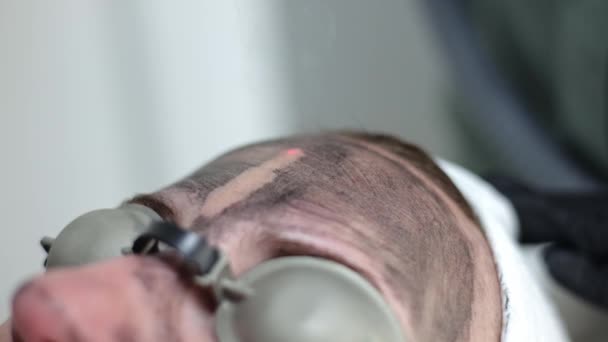 Профессиональный Косметолог Проводит Пилинг Кожи Использованием Углеродного Волокна Косметолог Проводит — стоковое видео