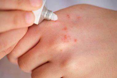 Kadın elinde egzama üzerine beyaz tıbbi kortikosteroid merhemi uyguluyor. Dermatit, alerji, sedef hastalığı konsepti..