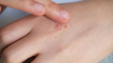 Kadın elinde egzama üzerine beyaz tıbbi kortikosteroid merhemi uyguluyor. Dermatit, alerji, sedef hastalığı konsepti..