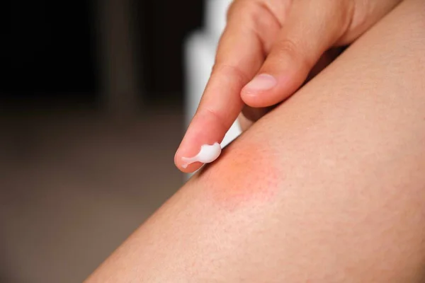 stock image Woman applying medicine cream on mosquito bite on her leg. Allergic reaction, itch, irritation due to insect bite concepts.