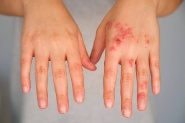 Patient hands with and without eczema comparison. Dermatitis, atopic skin. clipart
