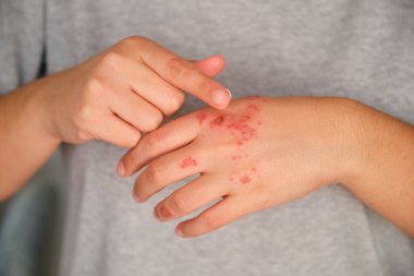 Patient hands applying ointment cream on eczema. Dermatitis, atopic skin. clipart