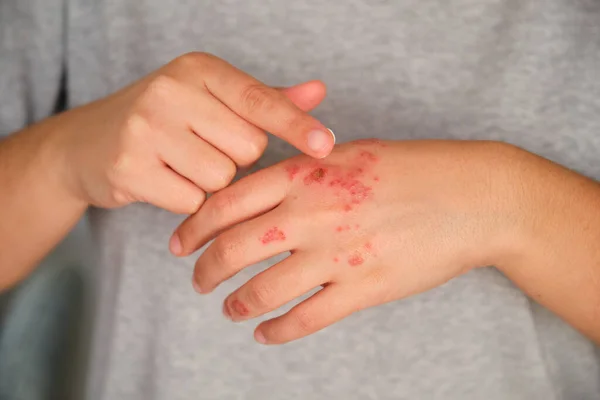 Patient hands applying ointment cream on eczema. Dermatitis, atopic skin.