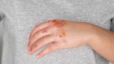 Hasta elleri egzama üzerine gül yağı sürüyor. Dermatit, atopik cilt doğal çaresi..