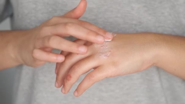Patientenhände Die Salbencreme Auf Ekzeme Auftragen Dermatitis Atopische Haut — Stockvideo