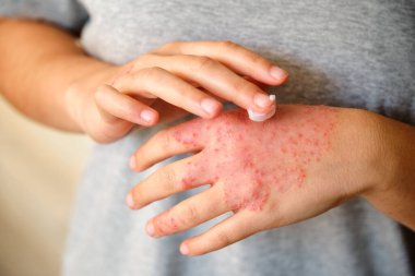 Tanımlanamayan bir kadın elinde egzama tedavisi için merhem sürüyor ya da nemlendirici krem sürüyor. Atopik dermatit..