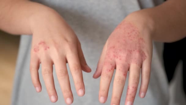 Oigenkännlig Kvinna Med Eksem Händerna Atopisk Dermatit Koncept — Stockvideo