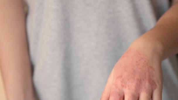 Unrecognizable Woman Supplements Pills Treatment Eczema Hand Atopic Dermatitis — Stock Video