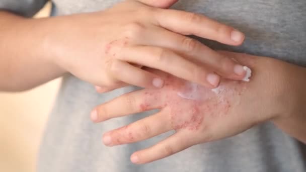 認識できない女性は 手の湿疹の治療に軟膏または保湿クリームを塗布し 皮膚炎上 — ストック動画