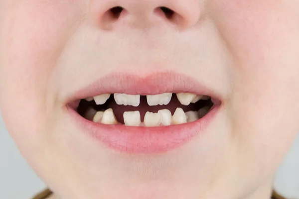 Στόμα Αγοριού Όμορφο Χαμόγελο Μεγαλώνοντας Νέα Δόντια Είναι Ορατά — Φωτογραφία Αρχείου