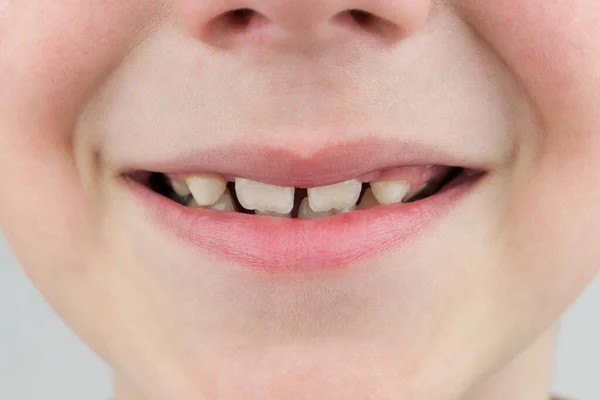 Usta Chłopca Piękny Uśmiech Rosnące Nowe Zęby Widoczne — Zdjęcie stockowe