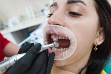 Klinikteki bir randevu sırasında dişlerinin kaplamasına eldiven takan bir ortodontistin yakın çekimi. Dişlerin restorasyonu yakın mesafede. Kaplamaları dolduruyorum. Diş bakımı. Güzel kar beyazı bir gülümseme.