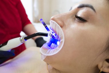 Dişlerin polimerizasyon lambasıyla yenilenmesi. Diş bakıcılarının kurulumu sırasında ağzı açık bir hastaya yakın çekim. Klinik randevusu sırasında diş kaplaması için eldiven takan ortodontist yakın plan.